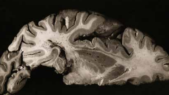 Imagen de corte del cerebro humano