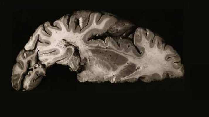 Imagen de corte del cerebro humano